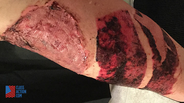 Пострадавший получил ожоги третьей степени